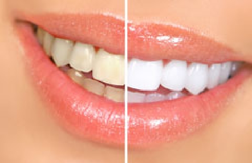 in office teeth whitening zoom Port Jefferson Station