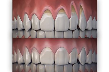 Port Jefferson Smiles - Karen Halpern DMD, MS - gum rejuvenation