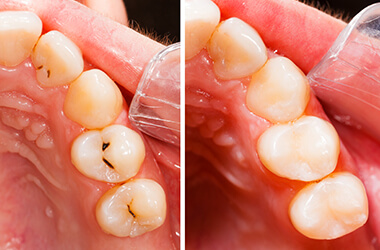 Port Jefferson Smiles-Karen Halpern DMD, MS-dental fillings