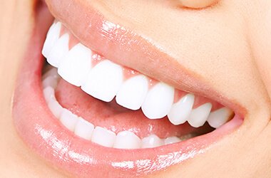 Port Jefferson Smiles-Karen Halpern DMD, MS-treatment white spot lesions 2